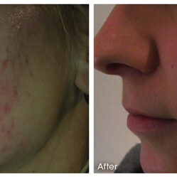 Before and after Microneedling