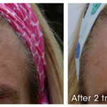 before after Microneedling