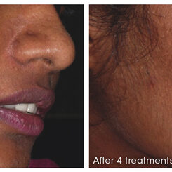 Before and after Microneedling