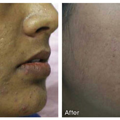 Before and after Microneedling