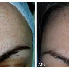 Before and after Microneedling