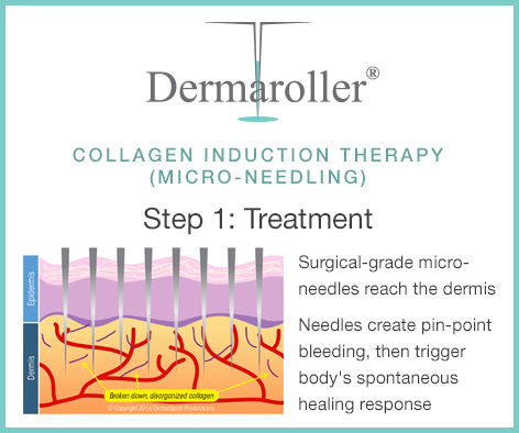 Dermaroller Collagen Induction treatment Step-1