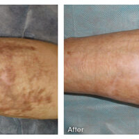 Before and after Microneedling