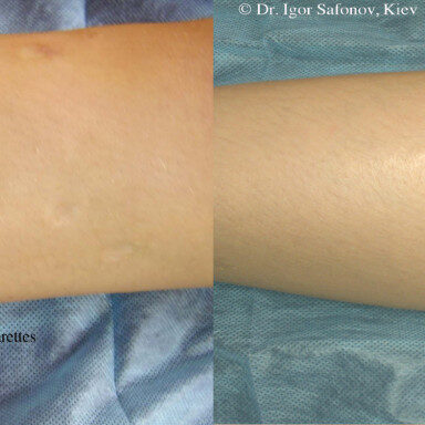 Before and after Microneedling