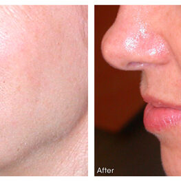 Before and after microneedling