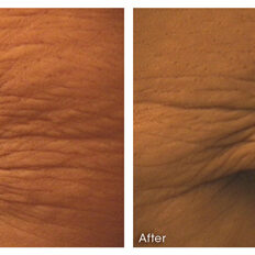 Before and after Microneedling