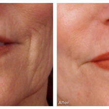 Before and after Microneedling